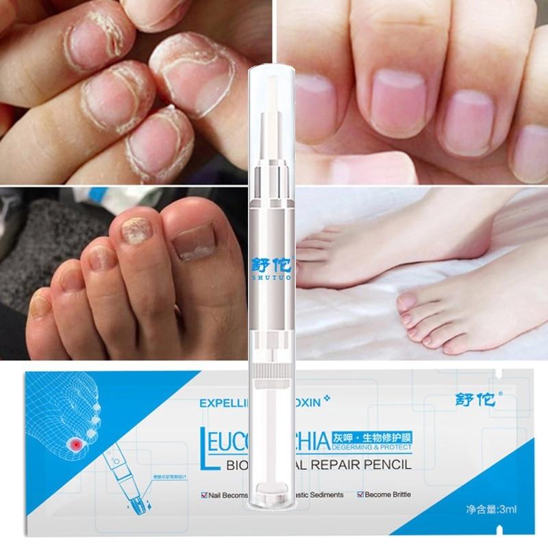 2 pcs - 3ML Chinese Herbal Fungal Nail Treatment Pen Repair Toe Fungal Onychomycosis Paronychia Anti Fungal Nail TSLM1|Nail Treatments