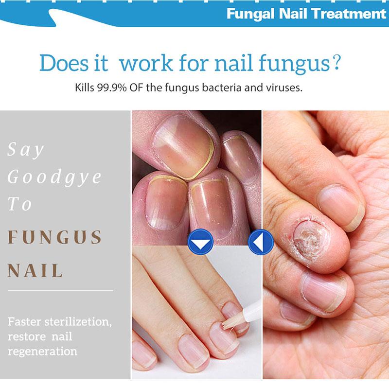 Powerful Nail Treatment Pen Onychomycosis Paronychia Anti Fungal Nail Infection Chinese Herbal Toe Fungus Care Repair Serum MS01|Nail Treatments