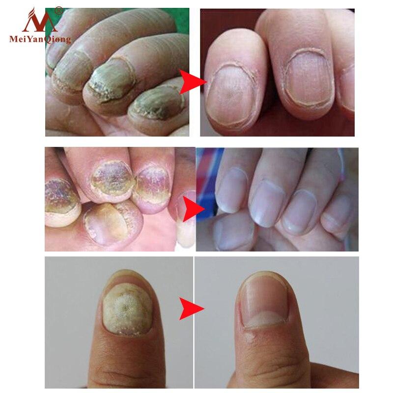 Fungal Nail Treatment Feet Care Essence Nail Foot Whitening Toe Nail Fungus Removal Gel Anti Infection Paronychia Onychomycosis|Nail Treatments