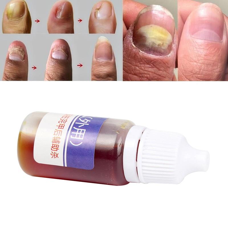 Nail Repair Fungal Nail Treatment Remove Toe Onychomycosis Remover Serum Nail Fungus Repair Treatment for Health Skin Care TSLM1|Nail Treatments