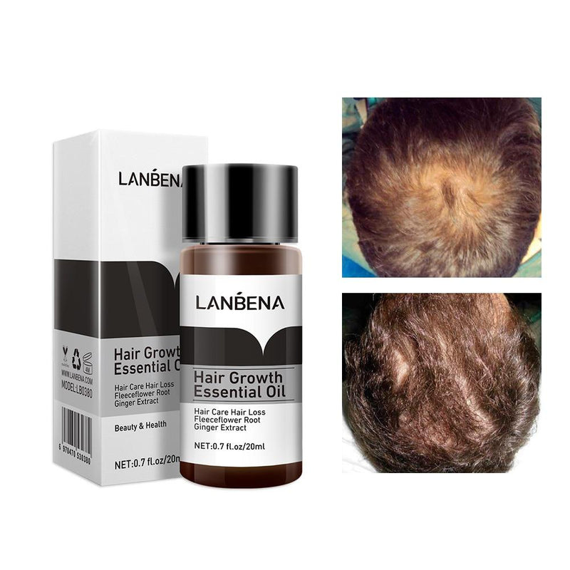 LANBENA Fast Powerful Hair Growth Essence Products Essential Oil Liquid Treatment Preventing Hair Loss Hair Care Andrea MSLQ01|Hair Loss Products