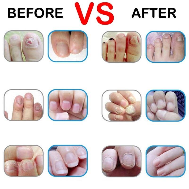 Onychomycosis Nail Repair Promote Regrow Nail Care Nail Essence Anti Infection Paronychia Leuconychia Toe Nails Removal Gel|Nail Treatments