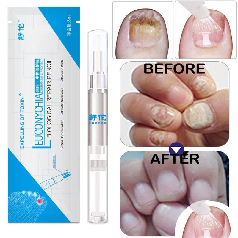 3ML Fungal Nail Treatment Anti Fungus Onychomycosis Paronychia Nail Chinese Herbal Nail Care Cell Regeneration TSLM1|Nail Treatments