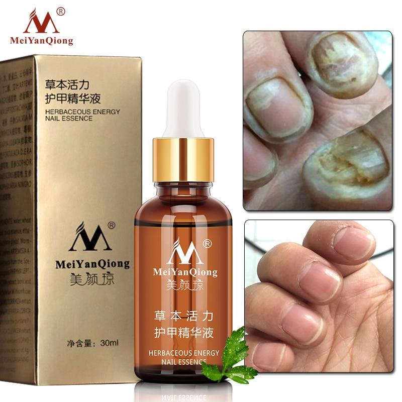 Nail Fungal Treatment Feet Care Essence Nail Foot Whitening Toe Nail Fungus Removal Gel Anti Infection Paronychia Onychomycosis|nail treatment|foot nailonychomycosis treatment