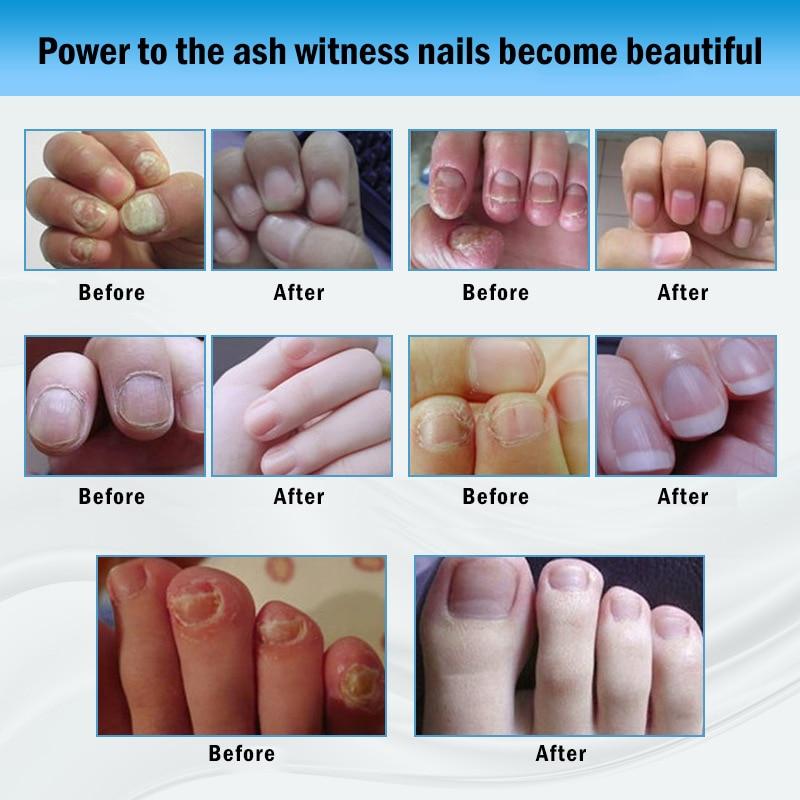 1PC Fungal Nail Treatment Pen Foot Toe Nail Fungus Onychomycosis Paronychia Chinese Herbal Care Medicinal Liquid TSLM2|Nail Treatments