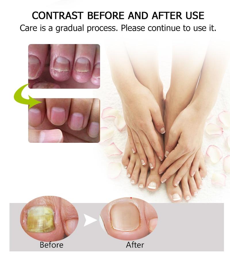 Fungal Nail Treatment Serum Nail Foot Nail Fungus Removal Gel Anti Infection Onychomycosis Nail Repair Essence Cream Feet Care|Nail Treatments