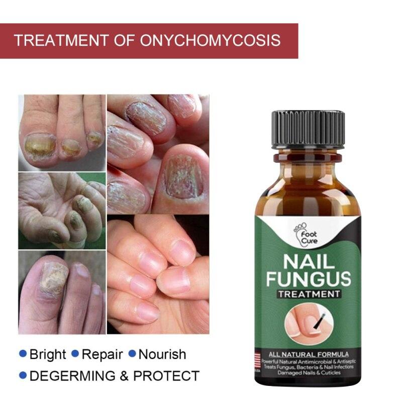 Hand Foot Nail Repair Liquid Hand And Foot Onychomycosis Care Repair Liquid Antifungal Thickening Soft Nail Care Fluid TSLM1|Nail Treatments