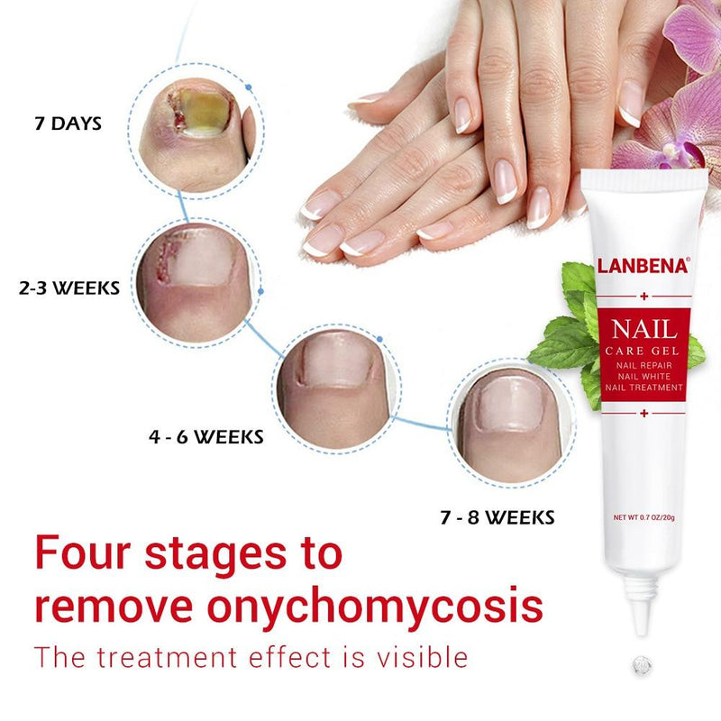 20g LANBENA Repair Nail Treatment Pen Onychomycosis Nail Fungus Gel Effective Anti Fungal Fingernails Toe Nails TSLM2|Nail Treatments