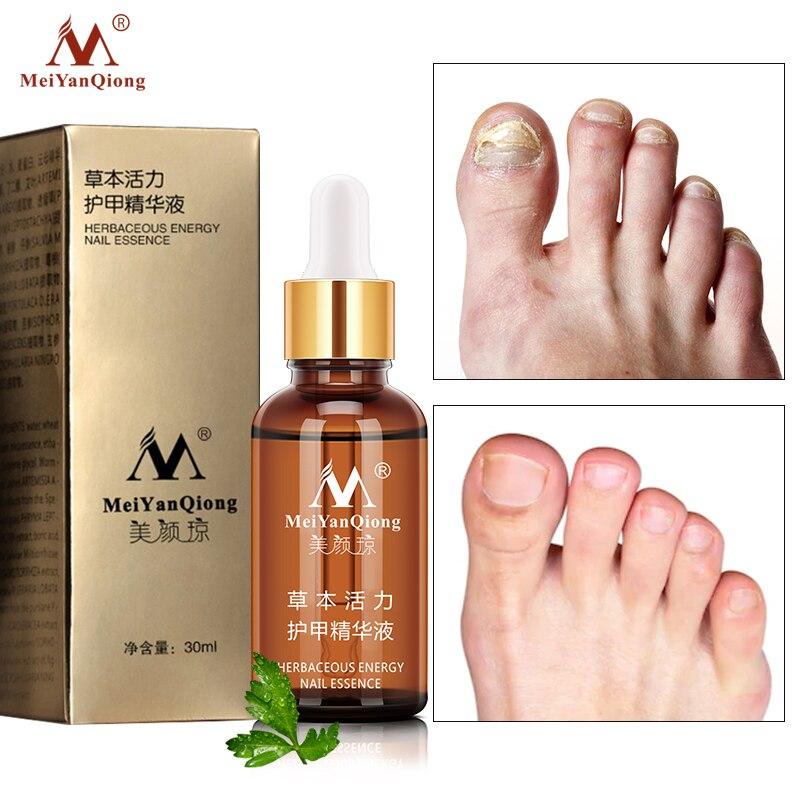 Fungal Nail Treatment Feet Care Essence Nail Foot Whitening Toe Nail Fungus Removal Gel Anti Infection Paronychia Onychomycosis|Nail Treatments