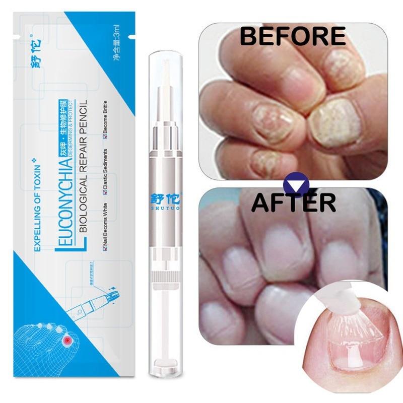 1PC 3ML Fungal Nail Treatment Pen Onychomycosis Paronychia Anti Fungal Nail Infection Chinese Herbal Care Medicinal Liquid TSLM2|Nail Treatments