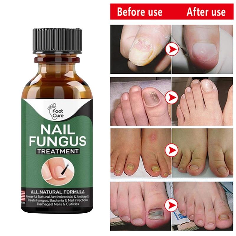 Hand Foot Nail Repair Liquid Hand And Foot Onychomycosis Care Repair Liquid Antifungal Thickening Soft Nail Care Fluid TSLM1|Nail Treatments