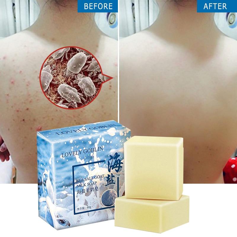 68g Removal Pimple Pore Acne Treatment Sea Salt Acne And Acarid Removing Soap Handmade Face Care Wash Basis Soap TSLM1|Soap