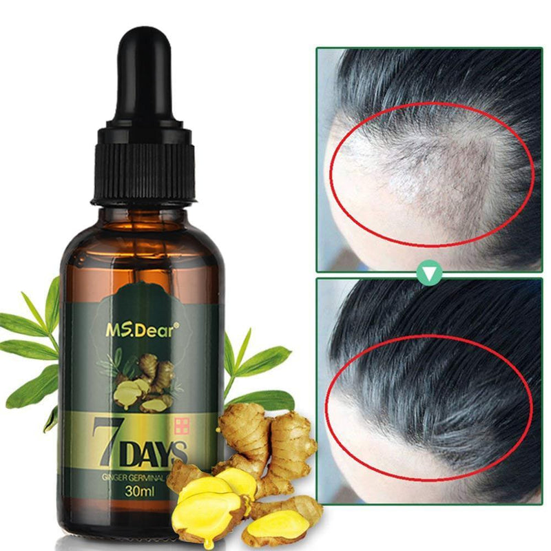 Hair Growth Essential Oils Ginger Germinal Oil Fast Hair Growth Anti Hair Loss Alopecia Treatment Beauty Dense Hair Growth Serum|Hair Loss Products