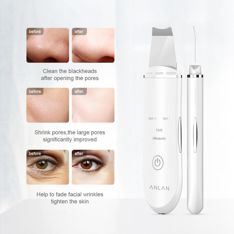 ANLAN Ultrasonic Skin Scrubber Deep Face Cleaning Machine Peeling Shovel Facial Pore Cleaner Face Skin Scrubber Lift Machine