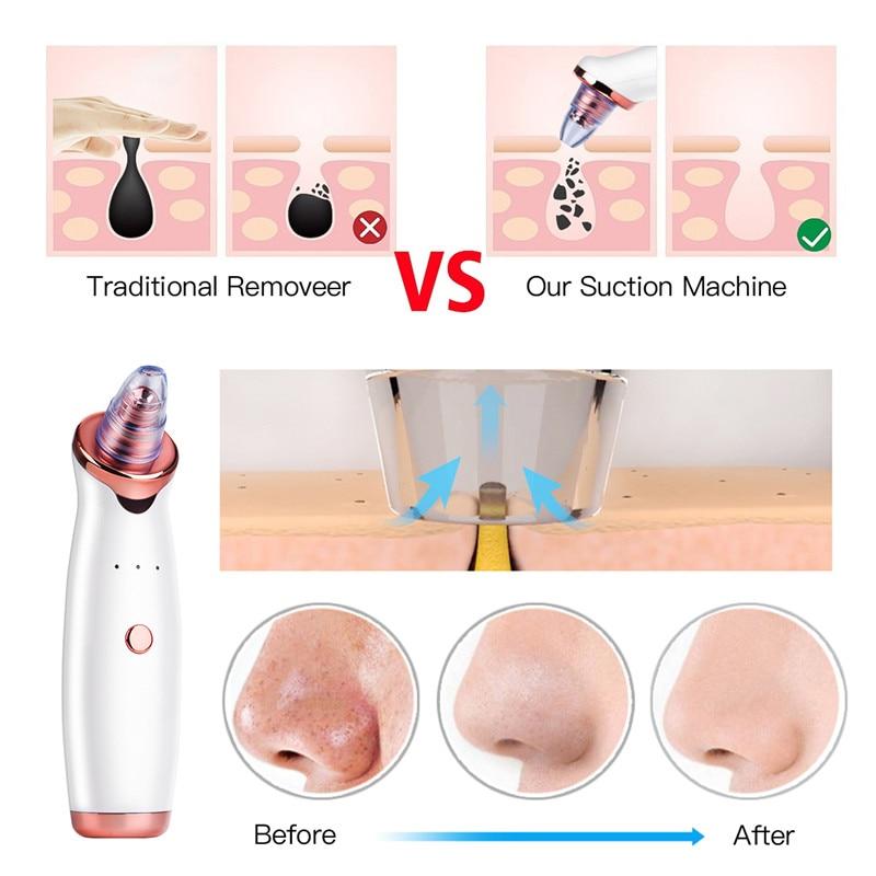 Microdermabrasion Blackhead Remover Vacuum Suction Face Pimple Acne Comedone Extractor Facial Pores Cleaner Skin Care Tools 38|Home Use Beauty Devices