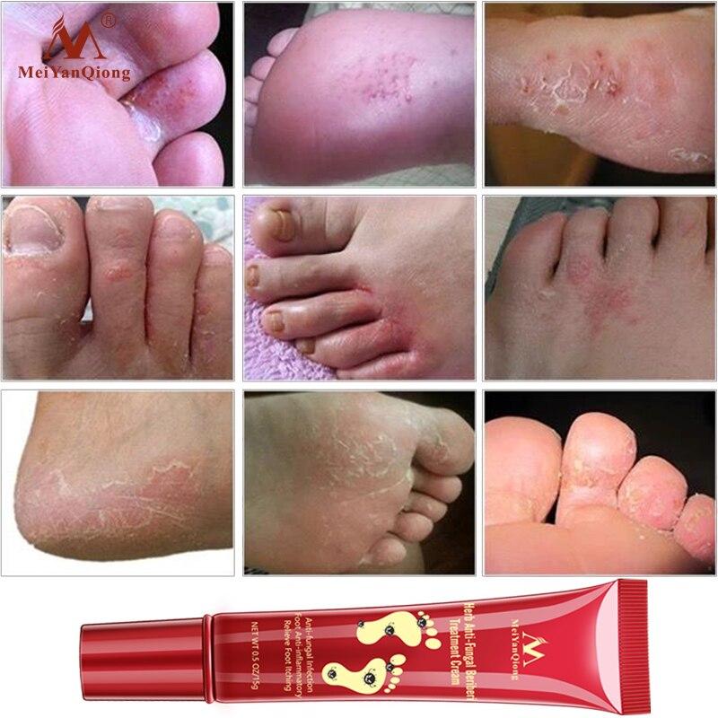 Foot Care Cream Foot spa Pedicure Herbal Detox Anti Fungal Infection Onychomycosis Fungus Treatment For legs|Feet