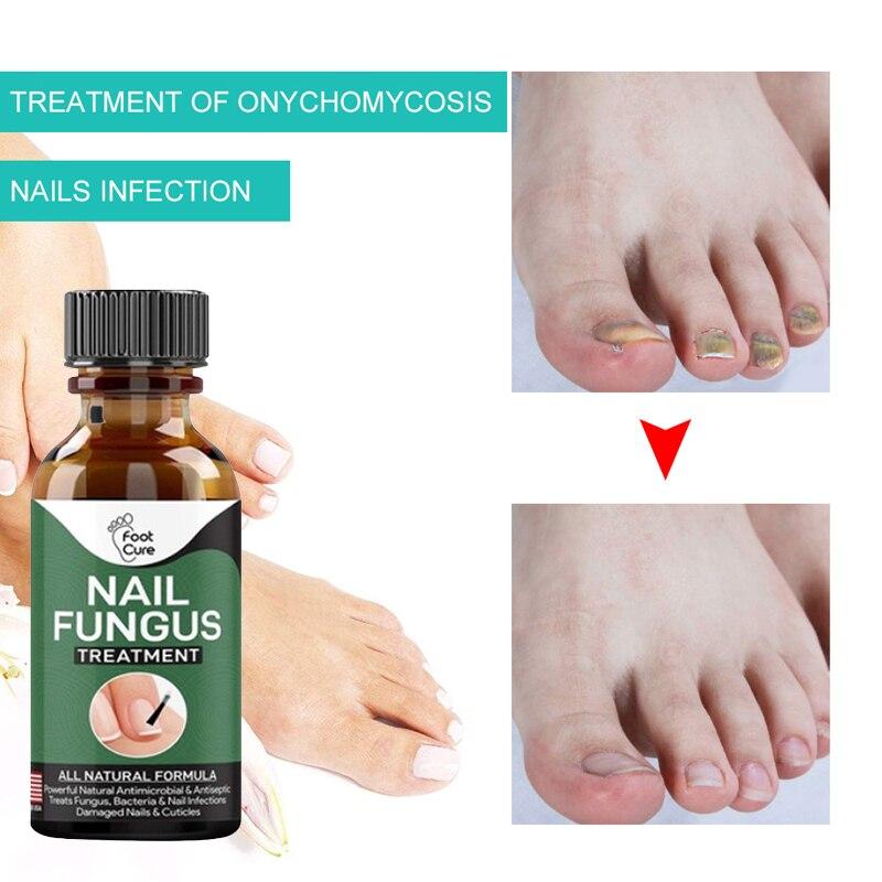 Hand Foot Nail Repair Liquid Hand And Foot Onychomycosis Care Repair Liquid Antifungal Thickening Soft Nail Care Fluid TSLM1|Nail Treatments