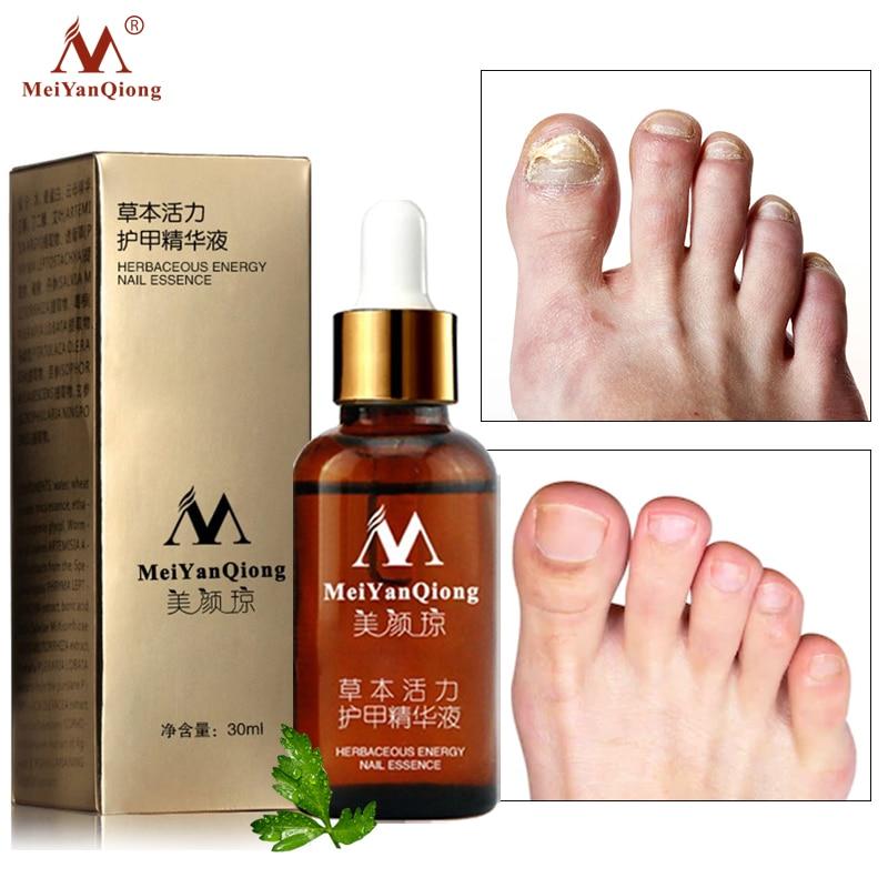 MeiYanQiong Fungal Nail Treatment Feet Care Essence Nail Foot Whitening Toe Nail Fungus Removal Gel Anti Infection Paronychia|Nail Treatments