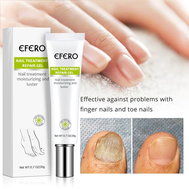 Fungal Nail Treatment Serum Nail Foot Nail Fungus Removal Gel Anti Infection Onychomycosis Nail Repair Essence Cream Feet Care|Nail Treatments