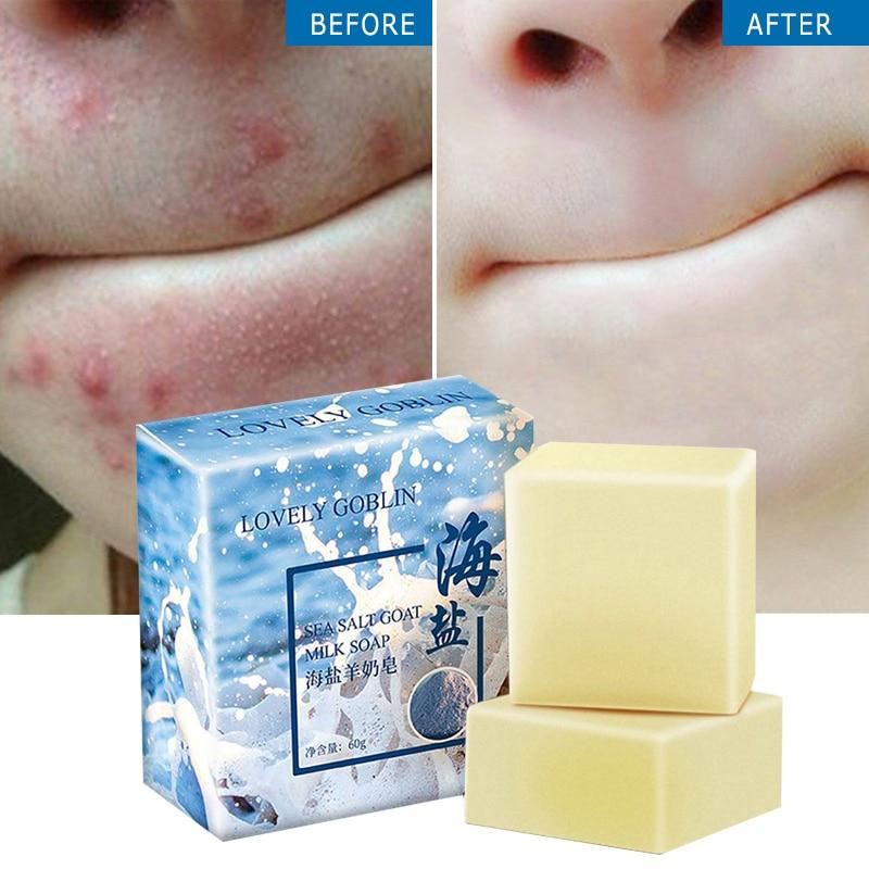 68g Removal Pimple Pore Acne Treatment Sea Salt Acne And Acarid Removing Soap Handmade Face Care Wash Basis Soap TSLM1|Soap