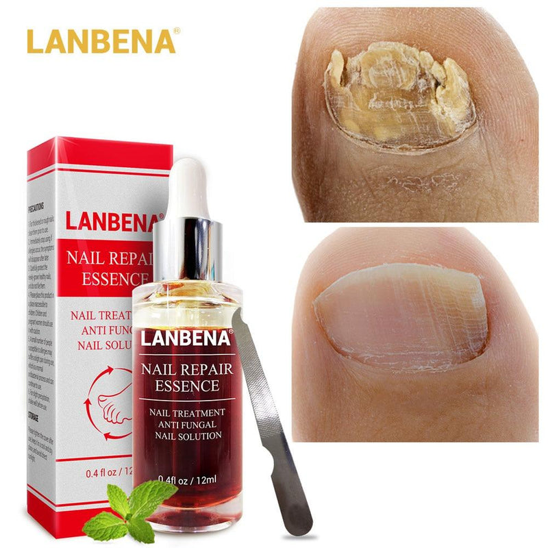 Fungal Nail Treatment Essence Nail and Foot Whitening Toe Nail Fungus Removal Whitening Onychomyco Feet Care Nail Gel Tools|gel pillow|gel windowgel pad