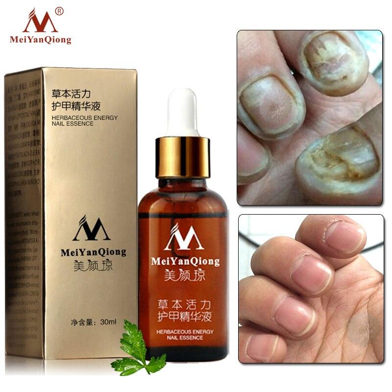 MeiYanQiong Fungal Nail Treatment Feet Care Essence Nail Foot Whitening Toe Nail Fungus Removal Gel Anti Infection Paronychia|Nail Treatments